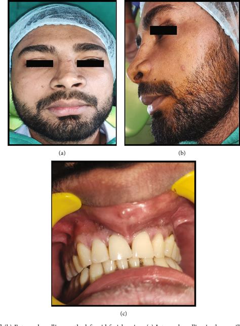 Figure 1 From Case Report Nasopalatine Duct Cyst With Impacted Inverted