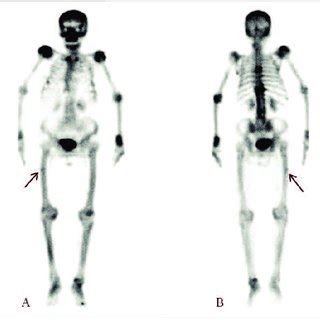 Plain X Rays Films Of The Left Femur A In Anterior Posterior View B