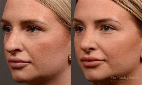 Rhinoplasty Before And After Case 461 Toronto Rhinoplasty Surgery