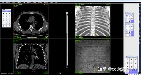 医院影像科pacs系统源码：三维重建之虚拟内窥镜（ve）是什么？怎么实现？ 知乎