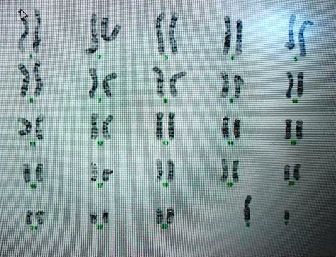 SOLVED Examine The Following Karyotype CAREFULLY And Select The