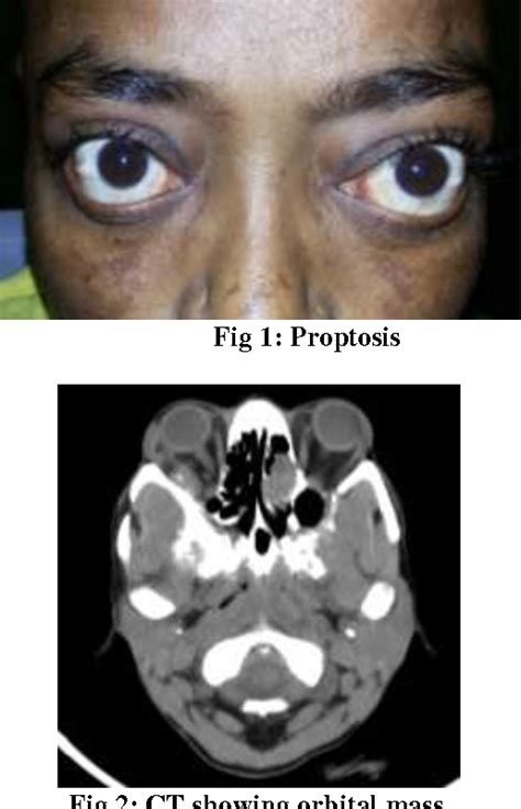 Figure 1 From Bilateral Metastatic Orbital Neuroblastoma In An Adult Semantic Scholar