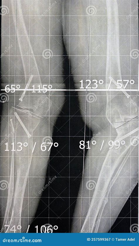 Bilateral Metaphyseal Genu Varum, Previous Epiphysiodesis, Left Distal Femur Valgus And Left ...