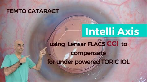 Innovative Use Of Cci And Toric Iol Combination Using Intelli Axis In