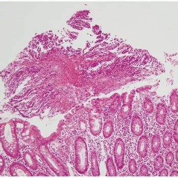 Endoscopic findings of the cecum showing multiple elevated yellow ...