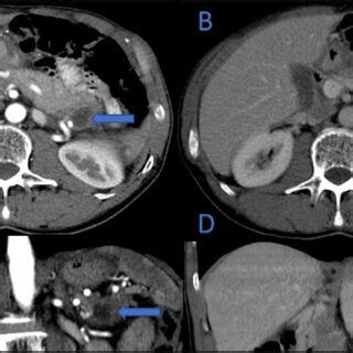 Ct Arterial And Portal Venous Phase Coronal Reconstruction Showing A