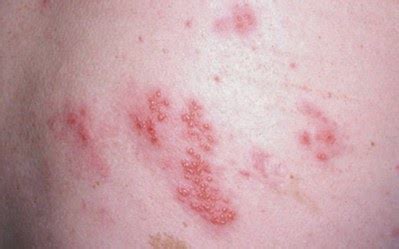 Hiv Rash Pictures Location Symptoms And Treatment