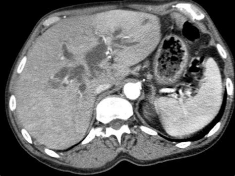 The Radiology Assistant Pancreatic Cancer Ct Staging 2 0