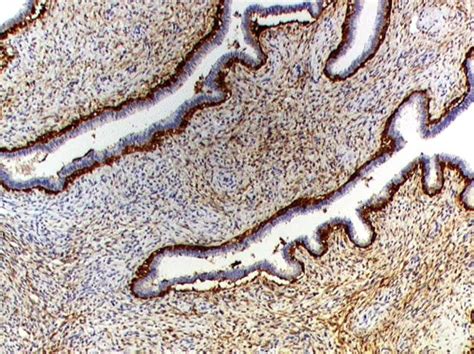 Photomicrograph Of The Same Benign Phyllodes Tumor As Shown In Figure