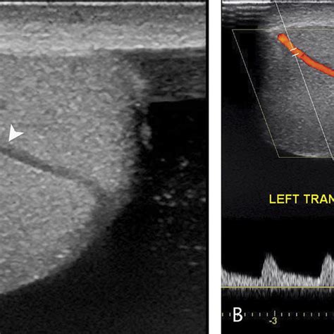 Senile Testicular Fibrosis Longitudinal Gray Scale Sonograms Of