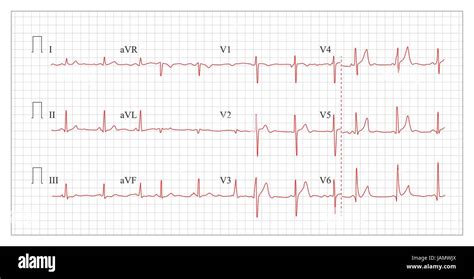 Coeur cardiogramme graphique vecteur Définir le rythme cardiaque en