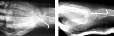 Postoperative A Anteroposterior And B Lateral Radiographs