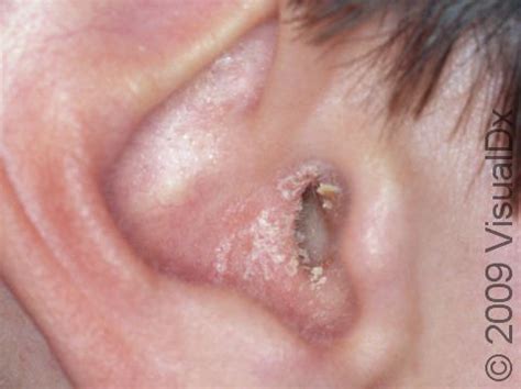 Seborrheic Eczema In Ear