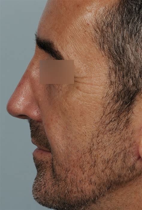 Photos De Rhinoplastie Avec Nez D Vi Ou Tordu Avant Et Apr S