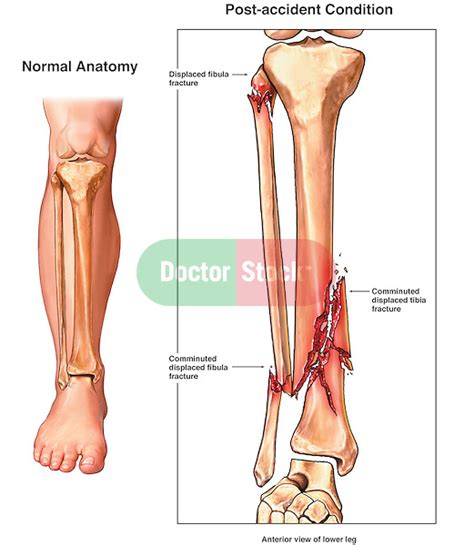 Comminuted And Compound Right Lower Leg Fractures Pilon Fracture