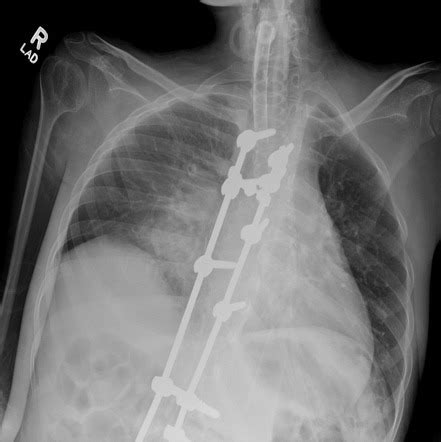 Duchenne Muscular Dystrophy Radiology Reference Article Radiopaedia Org