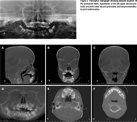 Figure 2 From Clinical And Radiographic Features Of Hutchinson Gilford