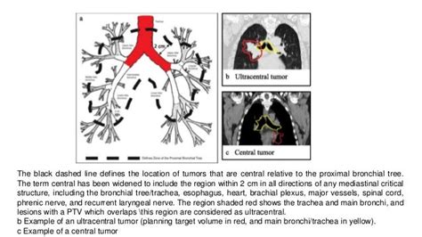 Role of SBRT in lung cancer