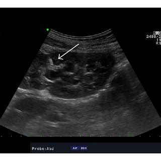 Establishing Renal Access Using Ultrasound Guidance A The Operative