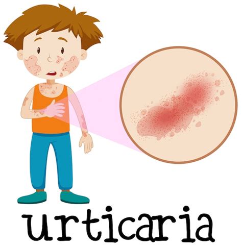 A Vector Of Skin Urticaria Premium Vector