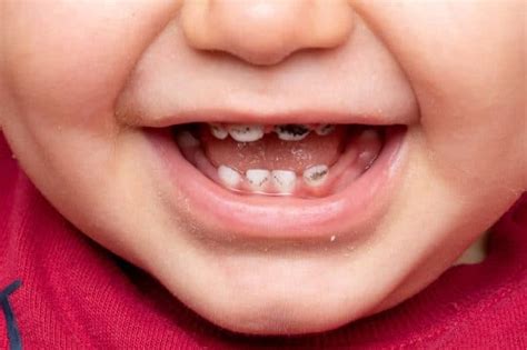 La Caries Dental S Ntomas Causas Prevenci N Y Tratamientos