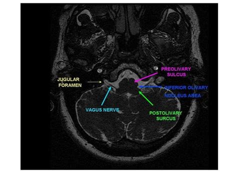 Radiologic anatomy of the cranial nerves | PPT