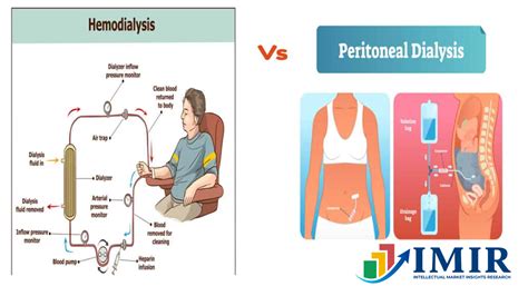 Hemodialysis Vs Peritoneal Dialysis