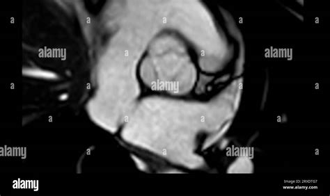 Mri Heart Or Cardiac Mri Magnetic Resonance Imaging Of Heart Showing Aortic Valve Stock