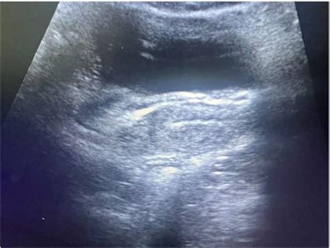 Ultrasonography Showing The Uterus Cervix And Vagina Without