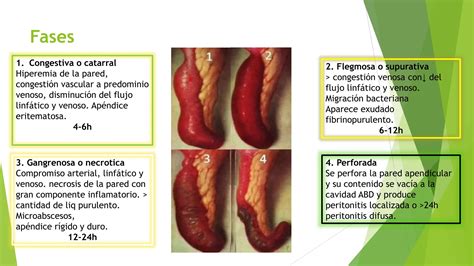 Abdomen Agudo Inflamatorio Apendicitis Pptx Descarga Gratuita