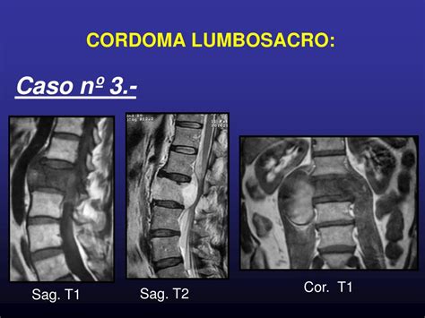 PPT CORDOMA LUMBOSACRO Diagnóstico por la Imagen PowerPoint