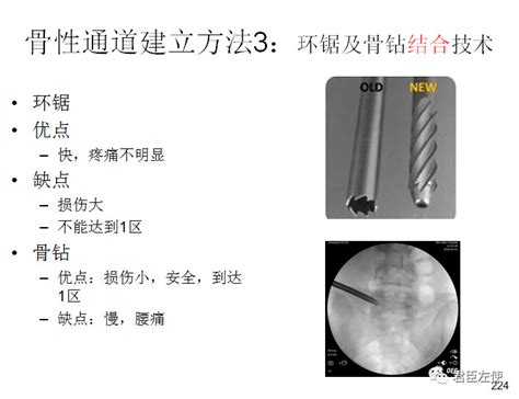 椎间孔镜 成型技巧 好医术早读文章 好医术 赋能医生守护生命