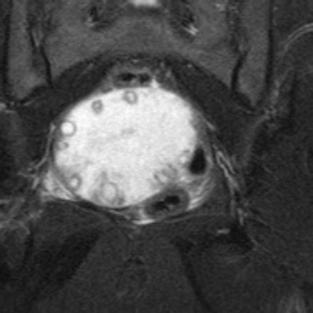 Ovarian Torsion Radiology Reference Article Radiopaedia Org