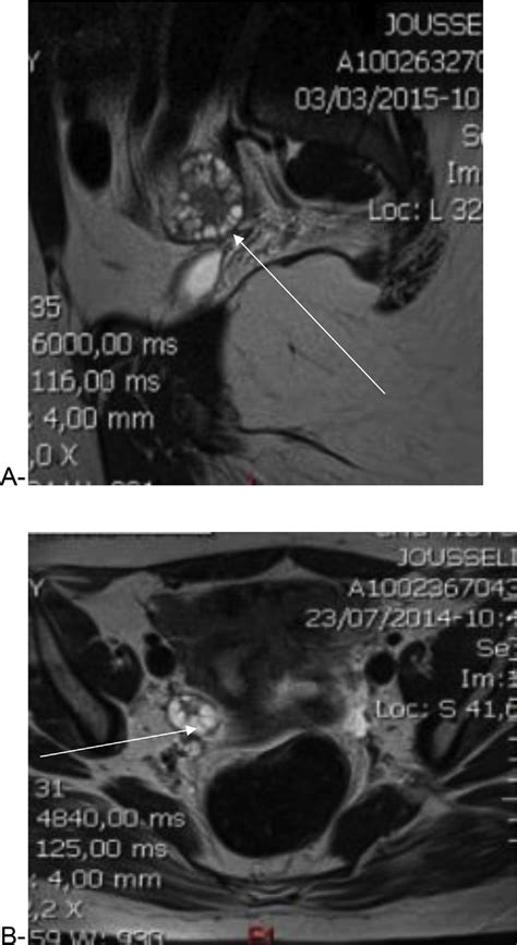 T2 Weighted Image Showing Multiple Peripherally Located Ovarian Cysts