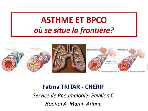 Ppt Asthme Et Bpco O Se Situe La Fronti Re Powerpoint Presentation