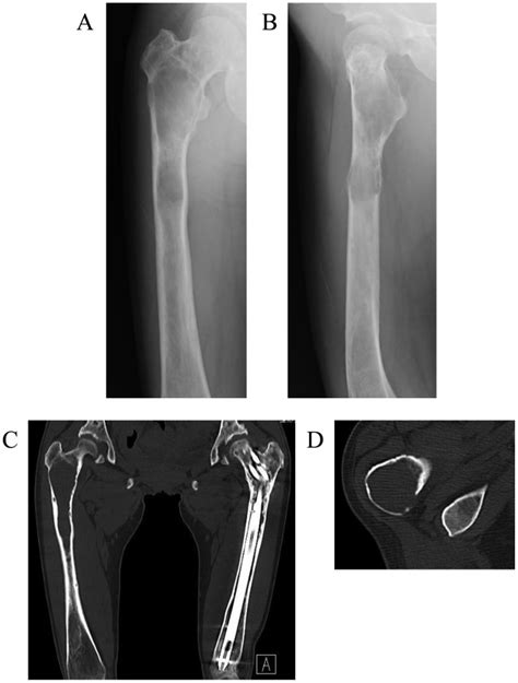 Diagnosis And Conservative Treatment Of A Rare Case Of Femoral Intraosseous Arteriovenous