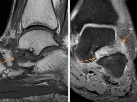 Sinus Tarsi Syndrome