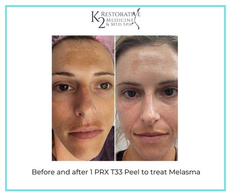 Prx T Non Peeling Biorevitalization Peel Birmingham Al