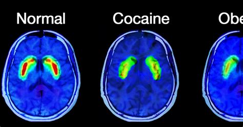 What Happens In The Brain Of An Addict Attn