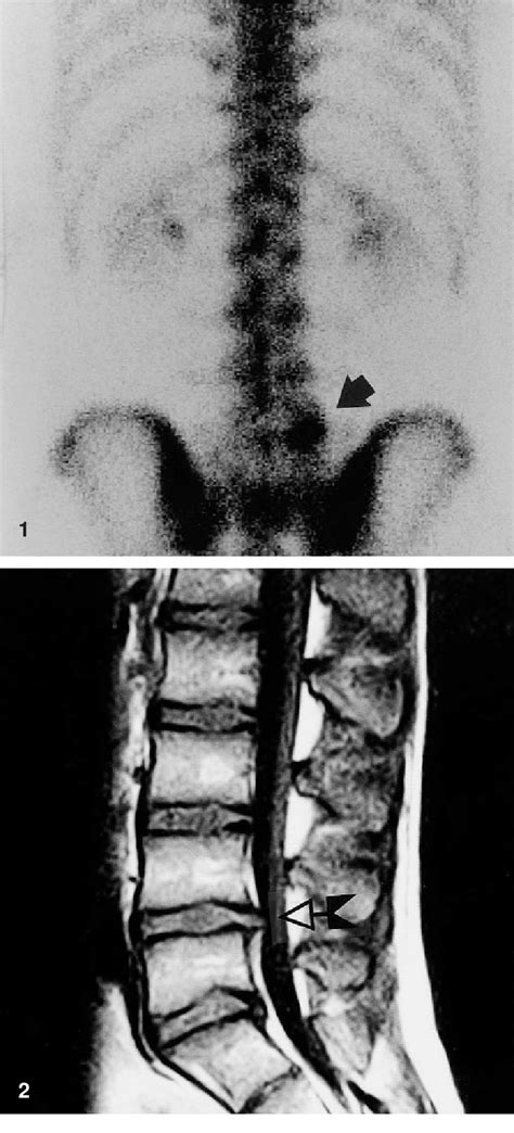 Posterior M Tc Mdp Bone Scan Shows Focal Increased Uptake Of The