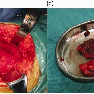 A Gross Appearance Of The Tumor With No Obvious Capsule Or Boundary