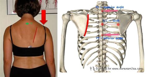 How To Truly Identify And Treat Thoracic Outlet Syndrome Tos Artofit