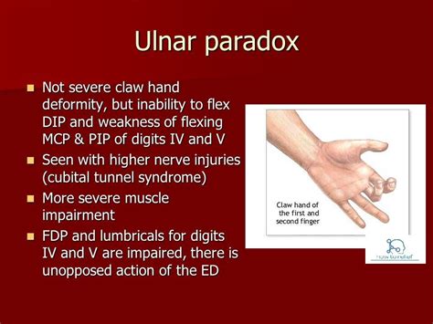 Ulnar Paradox