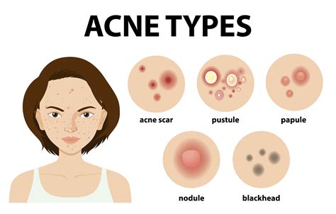 Types Of Acne On The Skin Or Pimples 1591090 Vector Art At Vecteezy