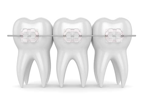 Pros and Cons of Ceramic Braces | Elara Orthodontics