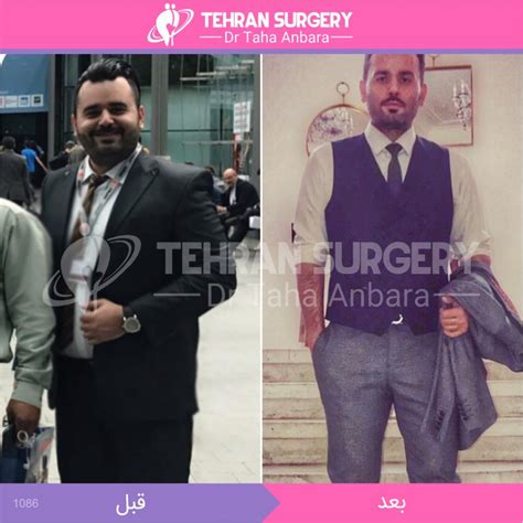 تصاویر قبل و بعد از جراحی چاقی جراح لاغری دکتر طاها عنبرا