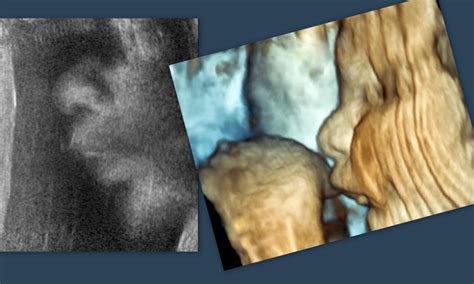 Ultrasound imaging: Amazing new 3D fetal ultrasound images