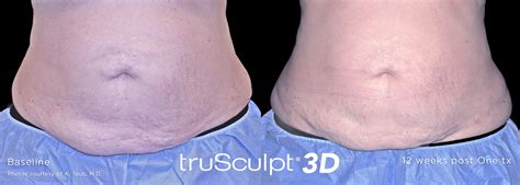 Trusculpt 3d Body Sculpting Face R X Medspa