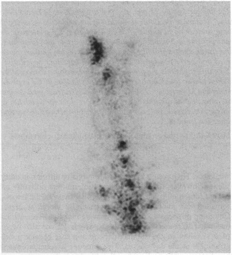 Bone scan Figure 2: Gallium scan | Download Scientific Diagram