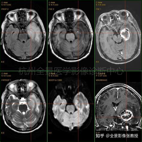 Pet多模态普通检查出“大脑杀手”—胶质瘤 知乎